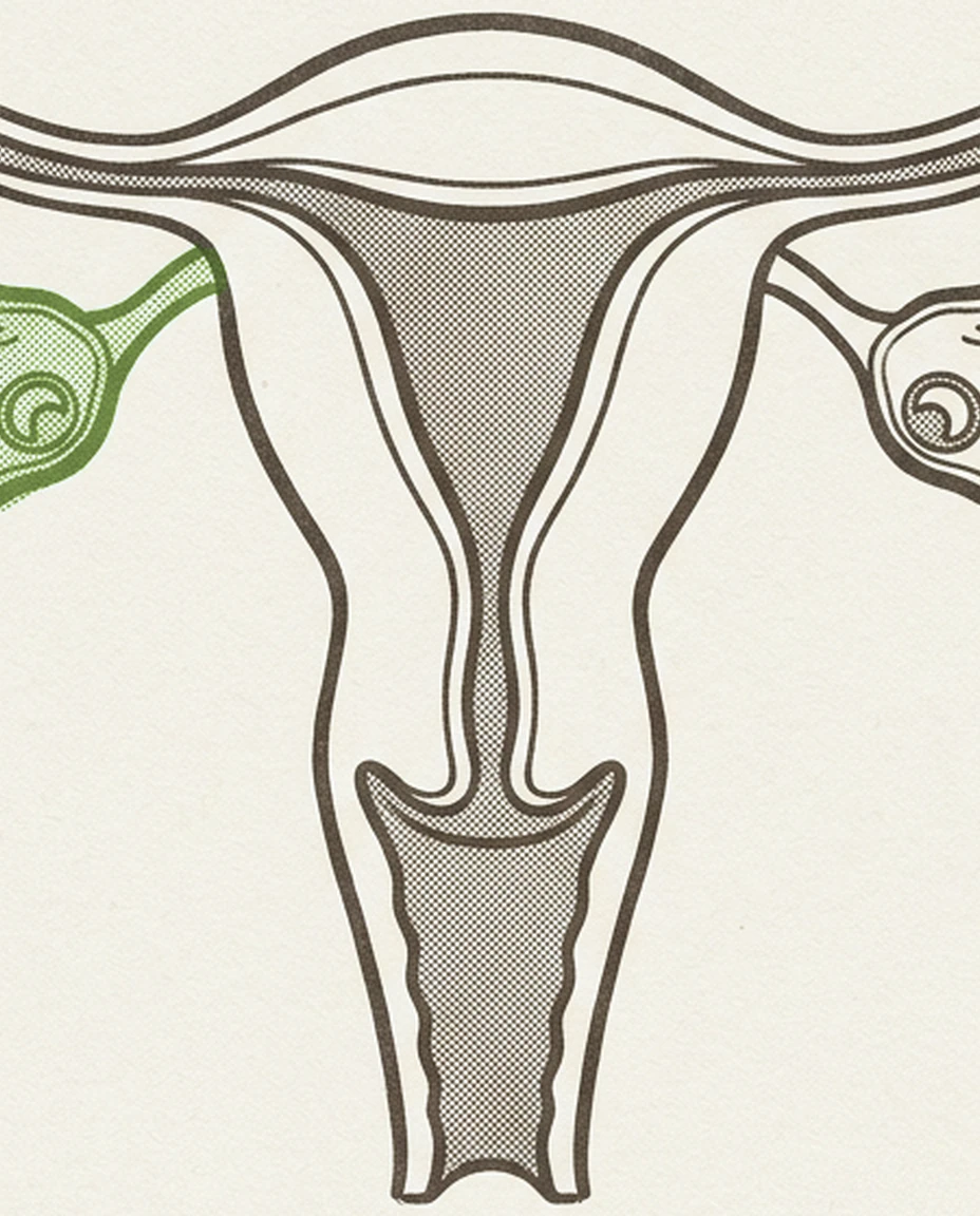 E-guide cover: PCOS